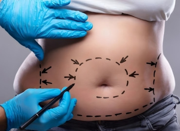 Ankara Karın Germe Ameliyatı ile Sıkı Bir Vücut Mümkün mü? Sarkmalara Kesin Çözüm