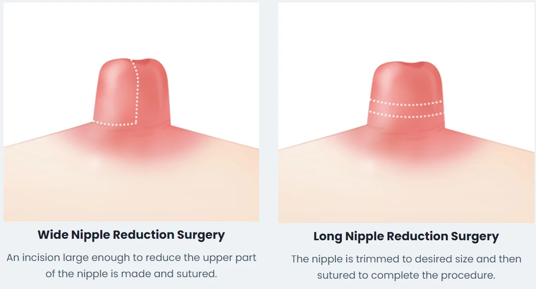 Meme Ucu (Nipple) Küçültme Ameliyatı Nedir?