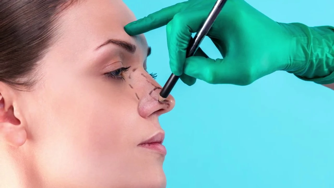 Doğal Burun Estetiği Ankara’da Nasıl Yapılır? Ameliyat Sonrası Yapay Görünümden Kurtulmak Mümkün mü?