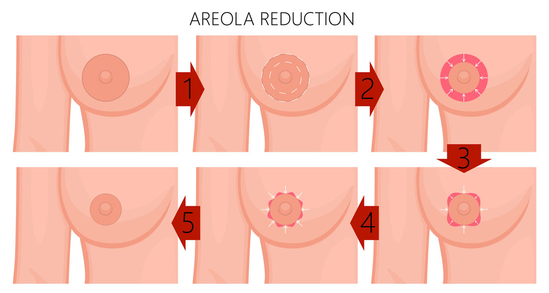 Areola Küçültme Estetiği Nedir? 