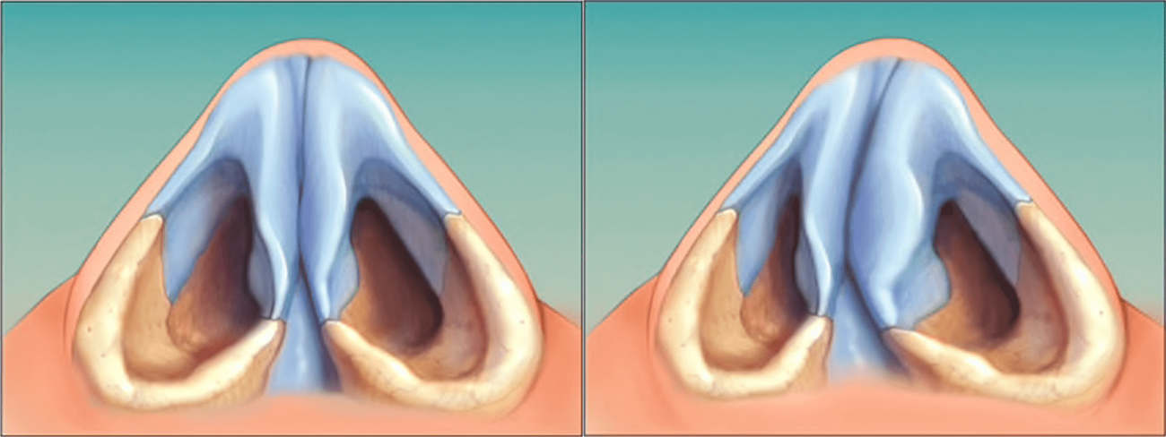 Septum Deviasyonu Nedir?